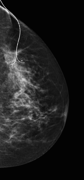 File:Carcinoma left breast (Radiopaedia 30017-30575 A 1).png