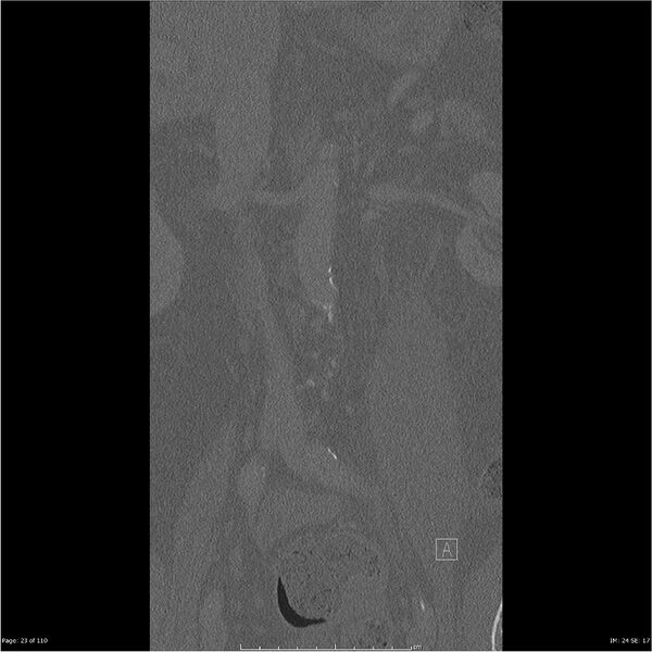 File:Cardiac trauma (Radiopaedia 32874-33858 Coronal bone window 23).jpg