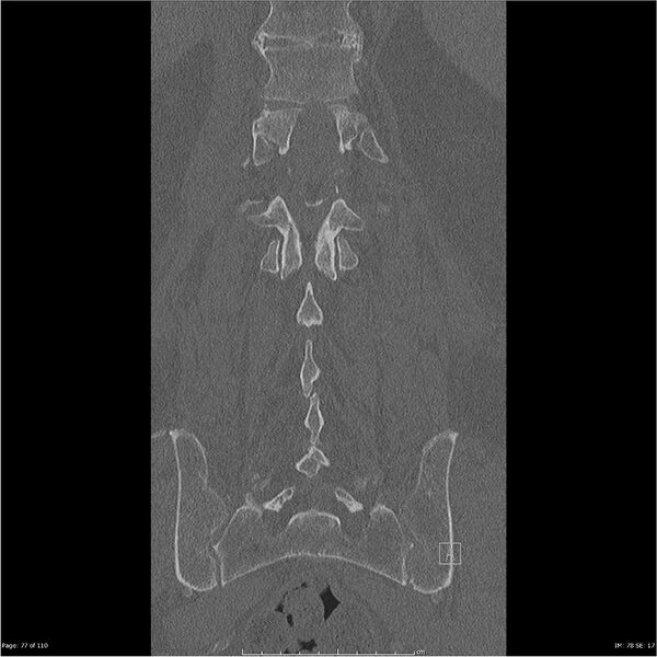 File:Cardiac trauma (Radiopaedia 32874-33858 Coronal bone window 77).jpg