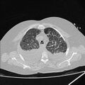 Cardiogenic pulmonary edema (Radiopaedia 29213-29609 Axial lung window 18).jpg