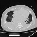 Cardiogenic pulmonary edema (Radiopaedia 29213-29609 Axial lung window 66).jpg