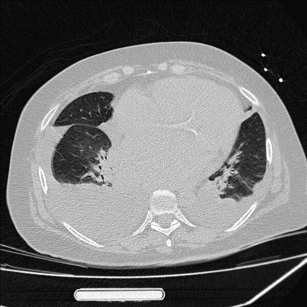 File:Cardiogenic pulmonary edema (Radiopaedia 29213-29609 Axial lung window 66).jpg