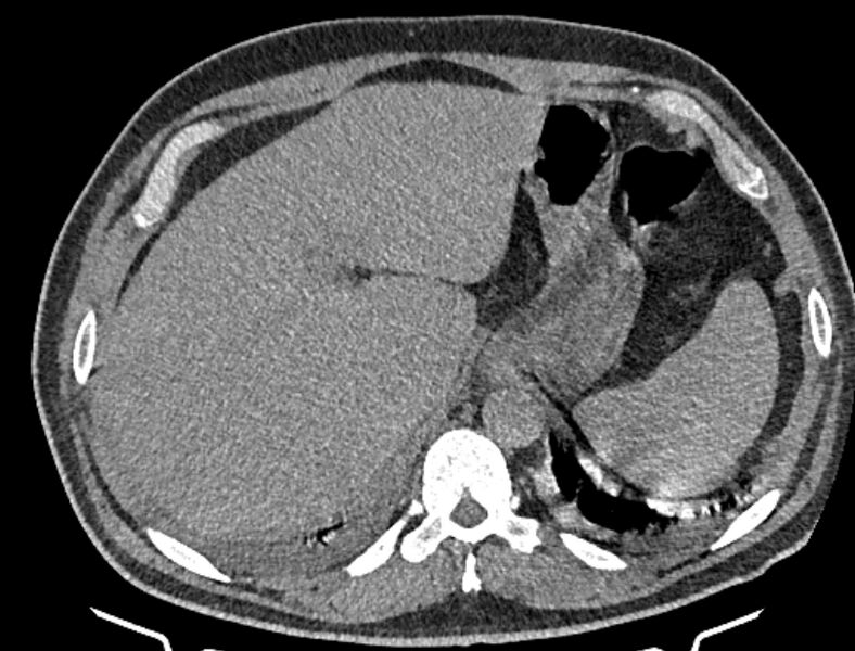 File:Cardiogenic pulmonary edema (Radiopaedia 68180-77678 Axial non-contrast 55).jpg
