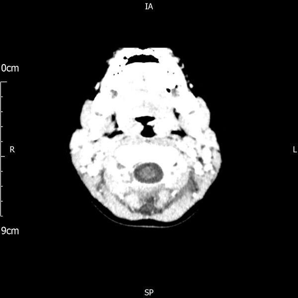 File:Cavernous sinus thrombosis (Radiopaedia 79414-92510 Axial Brain 30).jpg