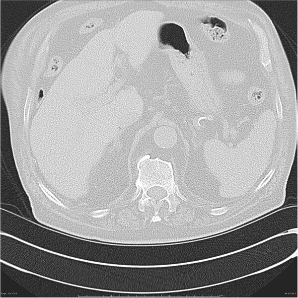 File:Cavitating left lower lobe lesion - squamous cell lung cancer (Radiopaedia 27749-28176 Axial lung window 50).jpg
