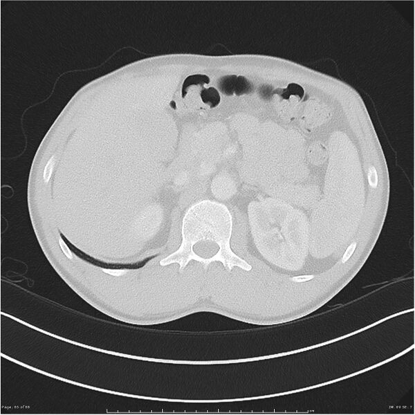 File:Cavitating lung cancer (Radiopaedia 25796-25945 Axial lung window 65).jpg