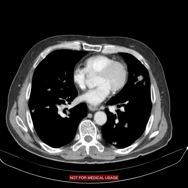 File:Cavitating pulmonary metastases (Radiopaedia 24920-25184 B 17).jpg