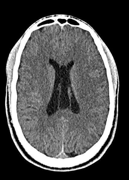 File:Cavum septum pellucidum and cavum vergae (Radiopaedia 77797-90060 Axial Brain Window 63).jpg