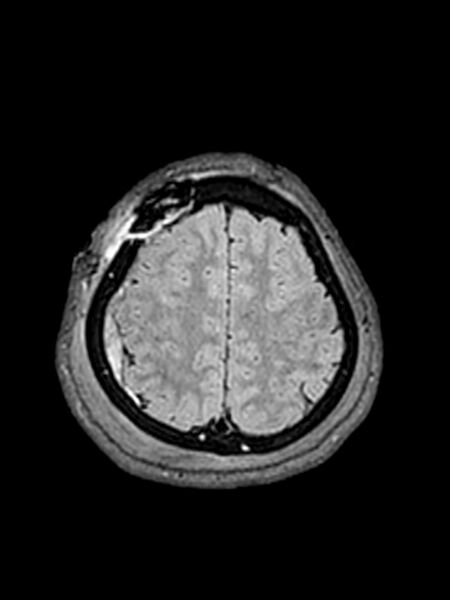 File:Central neurocytoma (Radiopaedia 79320-92381 Axial FLAIR 42).jpg