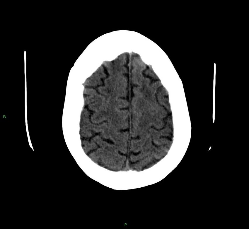 Cerebellar hemorrhage (Radiopaedia 58792-66026 Axial non-contrast 11).jpg