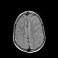 Cerebral abscess post cardiac surgery (Radiopaedia 27244-27420 Axial FLAIR 19).jpg