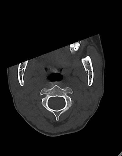 File:Cerebral abscesses (Radiopaedia 70458-80568 Axial bone window 2).jpg
