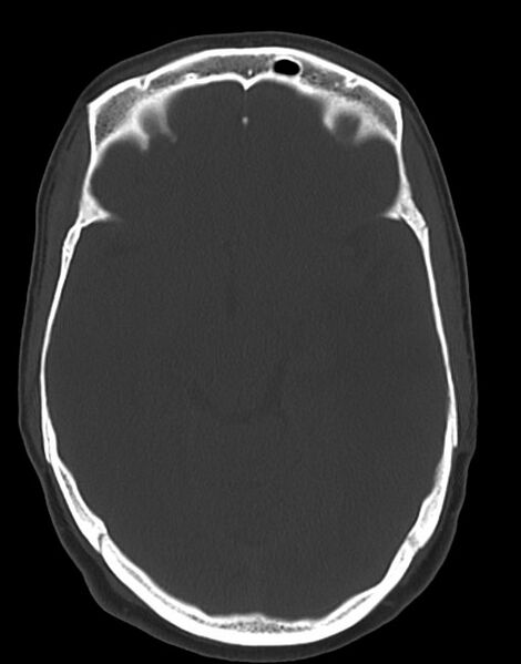File:Cerebral abscesses (Radiopaedia 70458-80568 Axial bone window 27).jpg