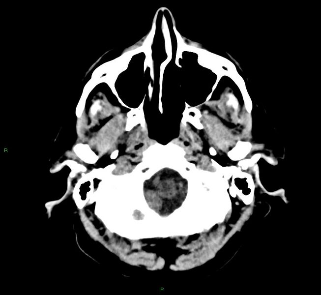 File:Cerebral amyloid angiopathy-associated lobar intracerebral hemorrhage (Radiopaedia 58376-65511 Axial non-contrast 50).jpg