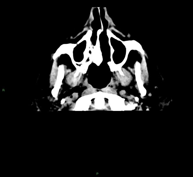 File:Cerebral amyloid angiopathy-associated lobar intracerebral hemorrhage (Radiopaedia 58376-65511 Axial non-contrast 55).jpg
