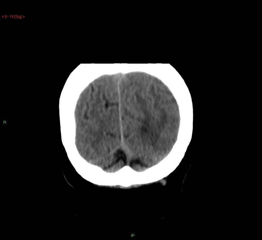 Cerebral amyloid angiopathy-associated lobar intracerebral hemorrhage (Radiopaedia 58378-65518 Coronal non-contrast 19).jpg