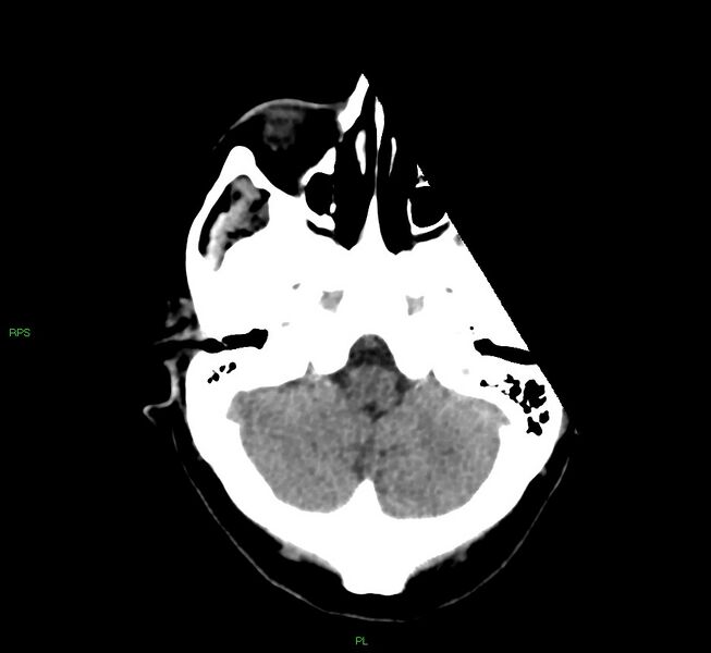 File:Cerebral amyloid angiopathy-associated lobar intracerebral hemorrhage (Radiopaedia 58569-65734 Axial non-contrast 48).jpg