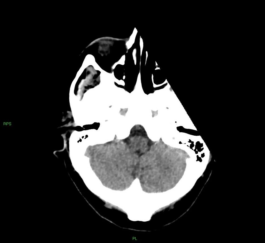 Cerebral amyloid angiopathy-associated lobar intracerebral hemorrhage (Radiopaedia 58569-65734 Axial non-contrast 48).jpg