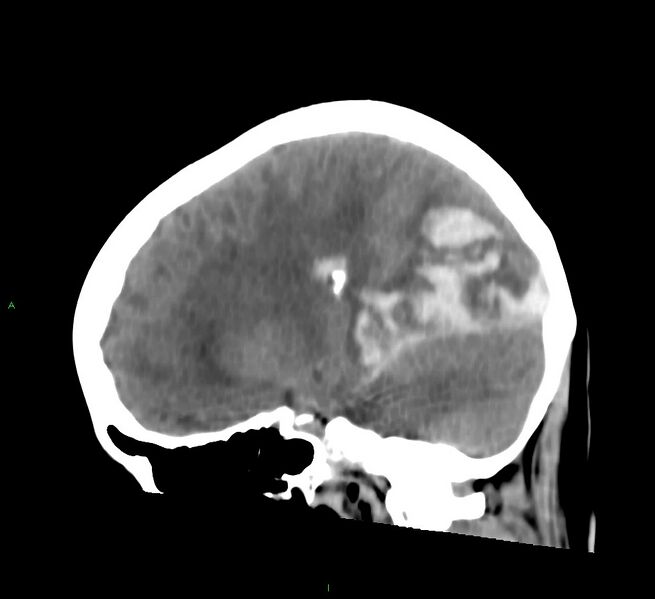 File:Cerebral amyloid angiopathy-associated lobar intracerebral hemorrhage (Radiopaedia 58754-65975 C 29).jpg
