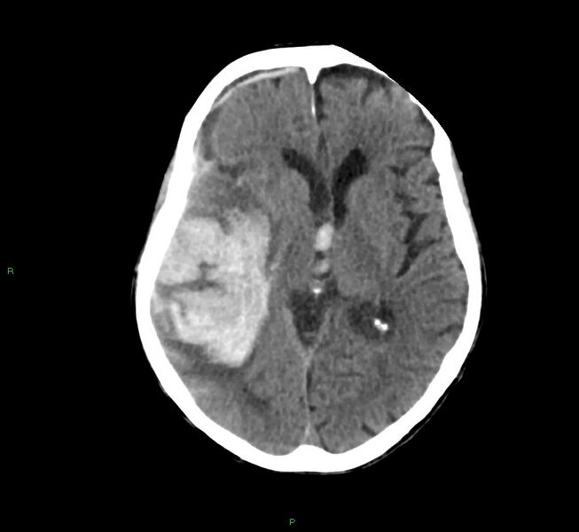 File:Cerebral amyloid angiopathy-associated lobar intracerebral hemorrhage (Radiopaedia 58758-65980 Axial non-contrast 26).jpg