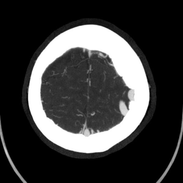 File:Cerebral arteriovenous malformation (Radiopaedia 43729-47189 B 43).jpg