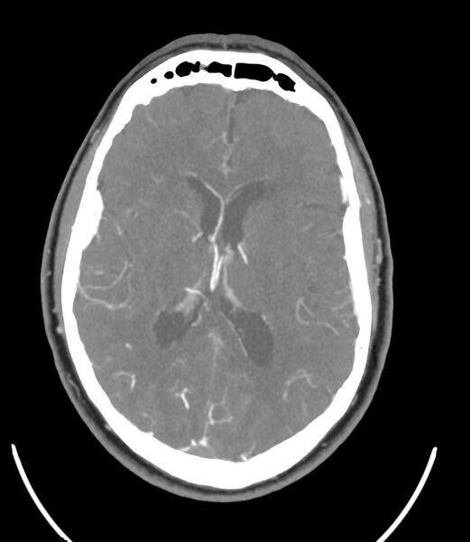 File:Cerebral dural venous sinus thrombosis (Radiopaedia 86514-102576 A 60).jpg