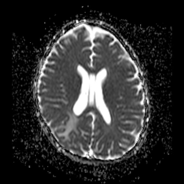 File:Cerebral tuberculoma (Radiopaedia 41152-43932 Axial ADC 14).jpg