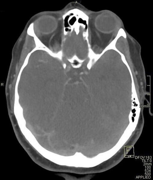 File:Cerebral venous sinus thrombosis (Radiopaedia 91329-108965 Axial venogram 31).jpg