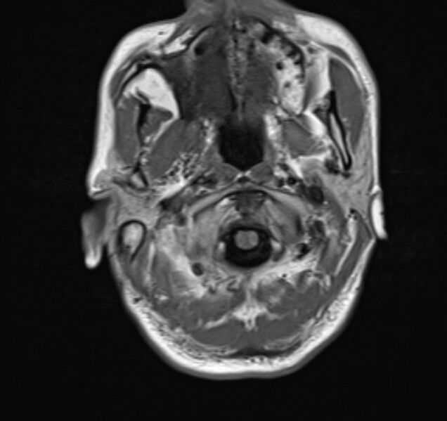 File:Cerebral venous thrombosis (Radiopaedia 71207-81504 Axial T1 2).jpg