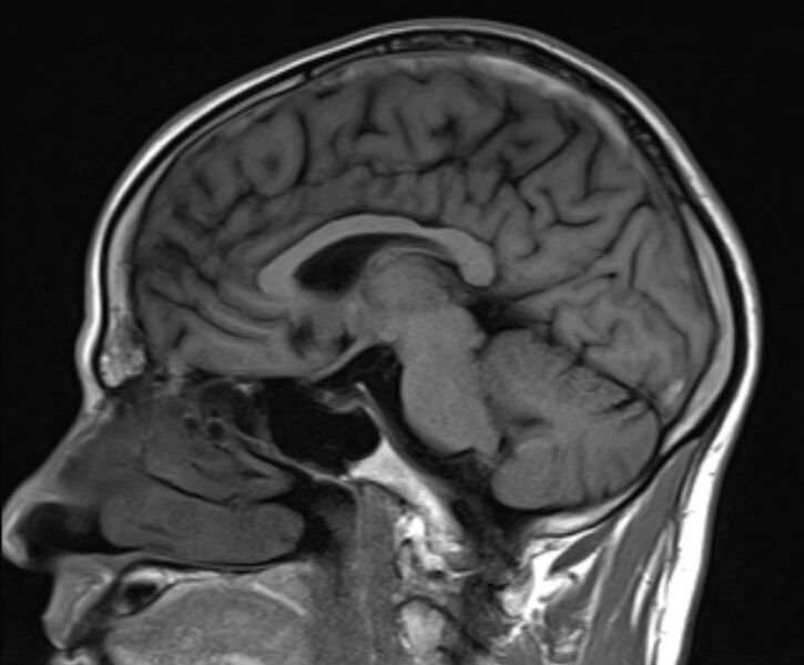 File:Cerebral venous thrombosis (Radiopaedia 71207-81504 Sagittal T1 14).jpg