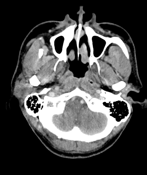 File:Cervical abscess (Radiopaedia 43725-47184 A 9).png
