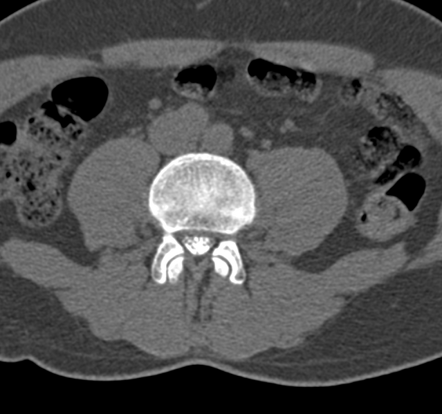 File:Cervical dural CSF leak on MRI and CT treated by blood patch (Radiopaedia 49748-54996 B 107).png