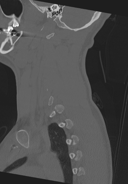 File:Cervical intercalary bone (Radiopaedia 35211-36748 Sagittal bone window 18).png