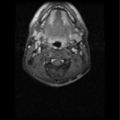 Cervical vertebrae metastasis (Radiopaedia 78814-91667 Axial T1 C+ fat sat 4).png