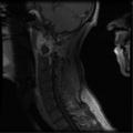 Cervical vertebrae metastasis (Radiopaedia 78814-91667 G 9).png