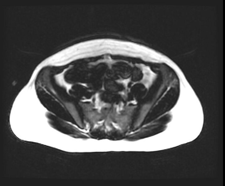 File:Cesarean section scar endometrioma (Radiopaedia 56569-63297 Axial T1 18).jpg