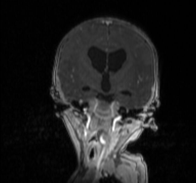 File:Chiari III malformation with occipital encephalocele (Radiopaedia 79446-92559 Coronal T1 C+ mpr 14).jpg