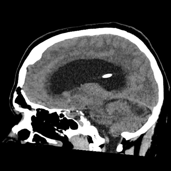 File:Chiasmatic-hypothalamic juvenile pilocytic astrocytoma (Radiopaedia 78533-91237 B 37).jpg