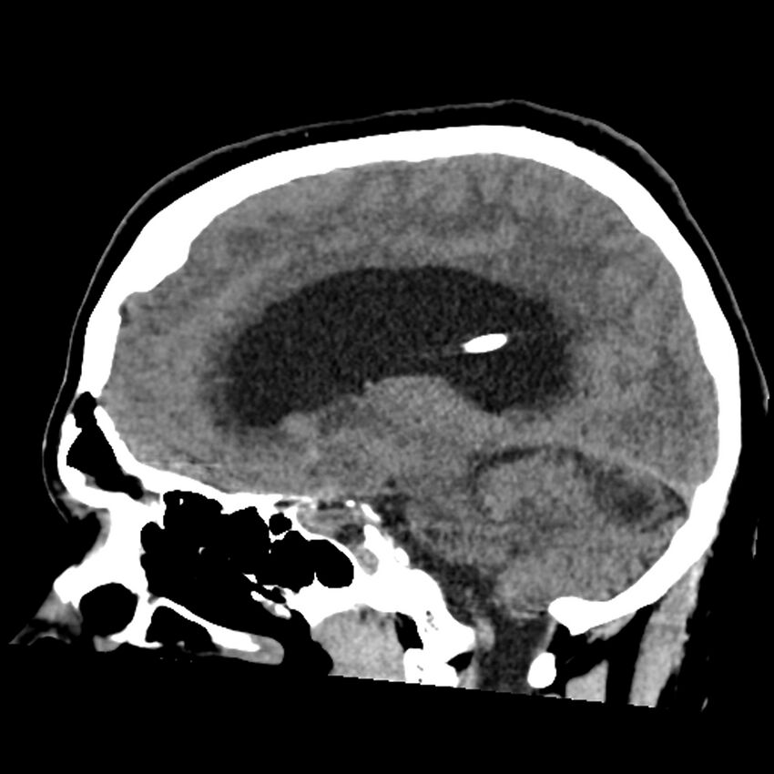 Chiasmatic-hypothalamic juvenile pilocytic astrocytoma (Radiopaedia 78533-91237 B 37).jpg