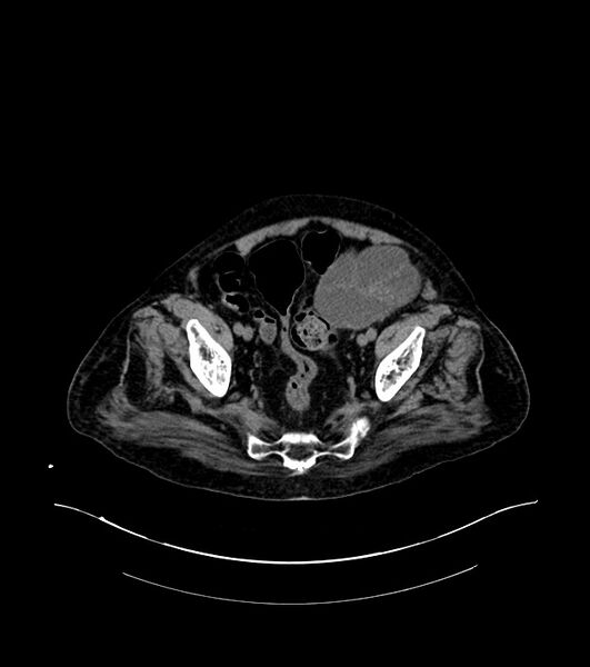 File:Cholangiocarcinoma with cerebral metastases (Radiopaedia 83519-98629 Axial non-contrast 107).jpg