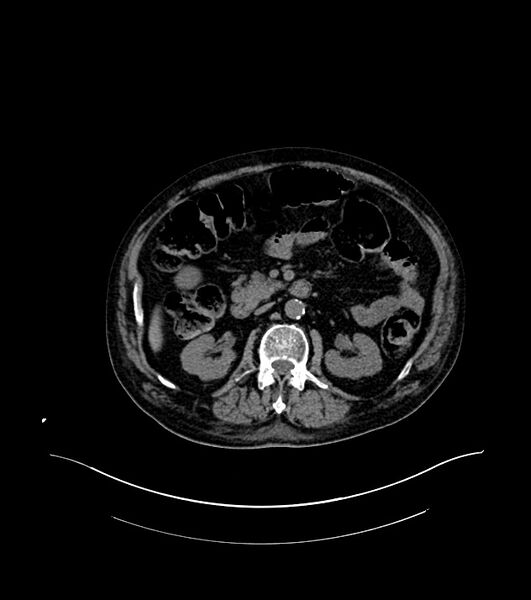 File:Cholangiocarcinoma with cerebral metastases (Radiopaedia 83519-98629 Axial non-contrast 44).jpg