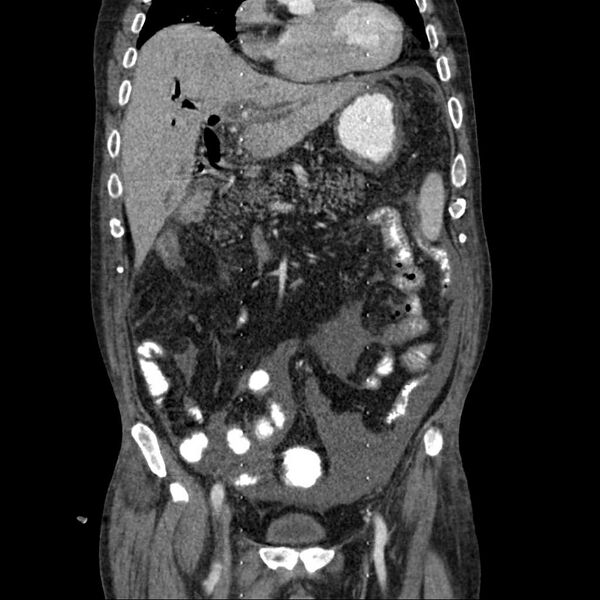 File:Cholangitis and abscess formation in a patient with cholangiocarcinoma (Radiopaedia 21194-21100 C 8).jpg