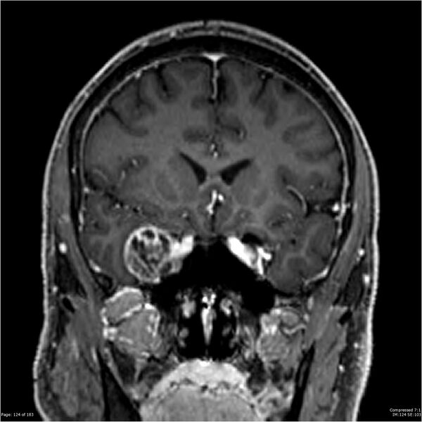 File:Chondrosarcoma of skull base- grade II (Radiopaedia 40948-43654 Coronal T1 C+ 35).jpg