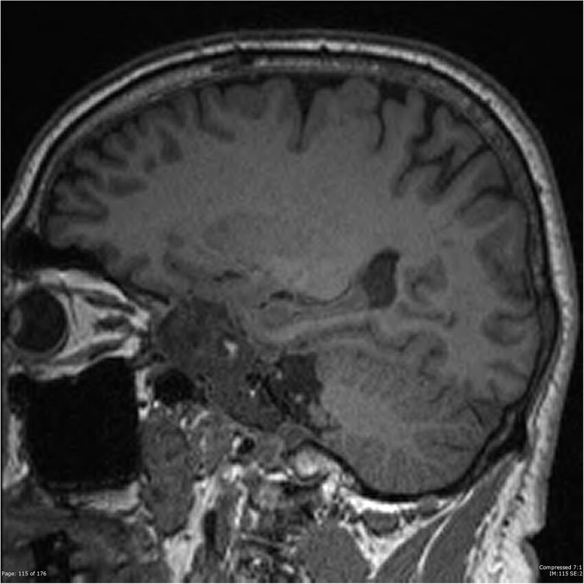 Chondrosarcoma of skull base- grade II (Radiopaedia 40948-43654 Sagittal T1 38).jpg