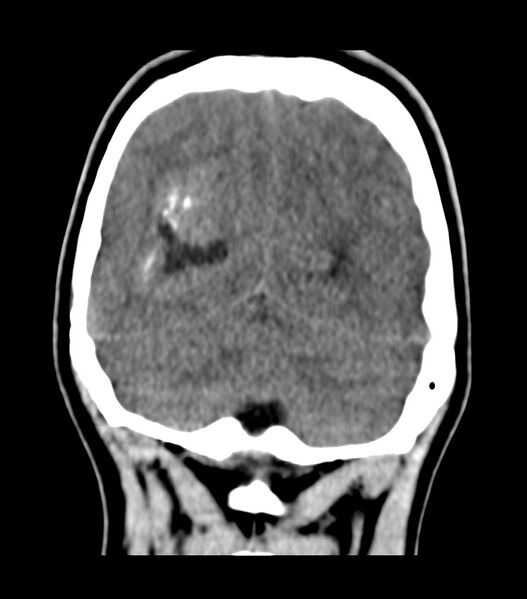 File:Choroid plexus carcinoma (Radiopaedia 91013-108552 Coronal non-contrast 70).jpg