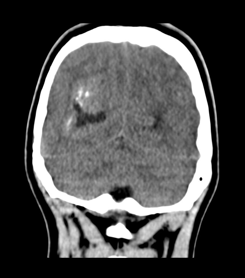 Choroid plexus carcinoma (Radiopaedia 91013-108552 Coronal non-contrast 70).jpg