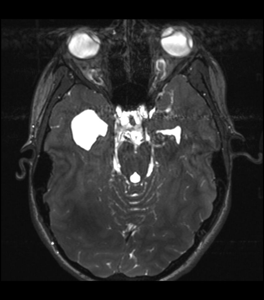 Choroid plexus carcinoma (Radiopaedia 91013-108553 Axial T2 CISS 10).jpg