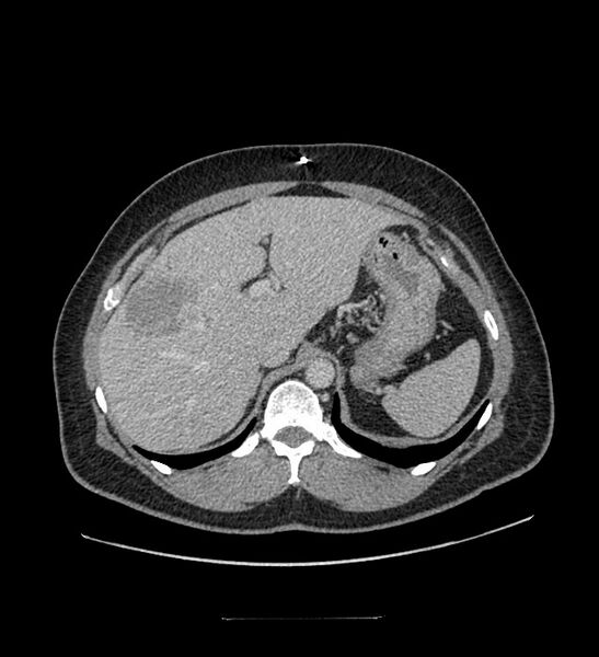 File:Chromophobe renal cell carcinoma (Radiopaedia 84337-99644 C 33).jpg