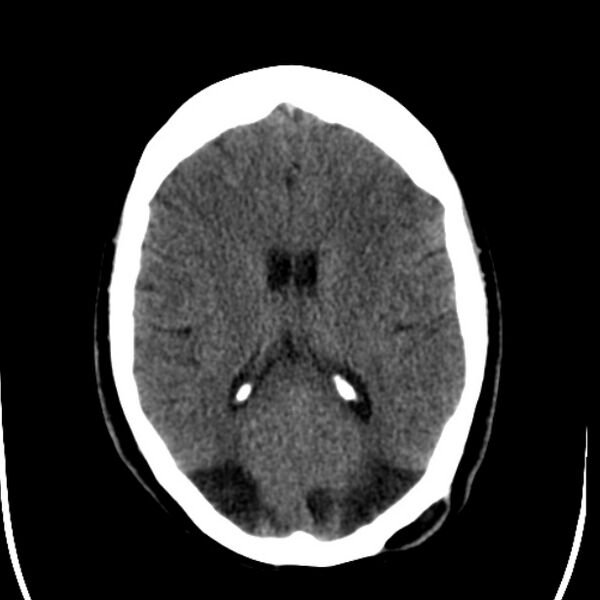 File:Chronic bilateral occipital lobe infarcts (Radiopaedia 31276-31996 Axial non-contrast 25).jpg