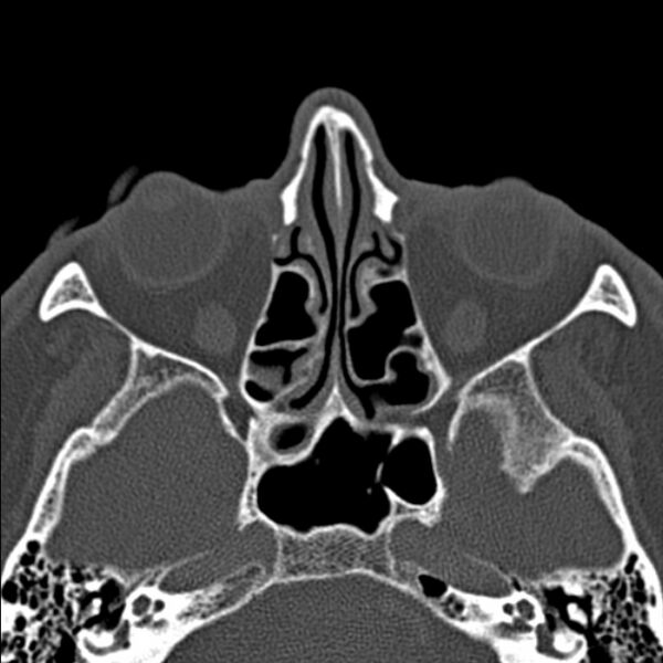 File:Chronic maxillary sinusitis (Radiopaedia 27879-28116 Axial bone window 29).jpg